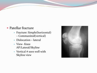  Patellar fracture
 Fracture: Simple(horizontal)
– Communited(vertical)
 Dislocation – lateral
 View- Knee
AP/Lateral/Skyline
 Vertical # seen well with
Skyline view
 