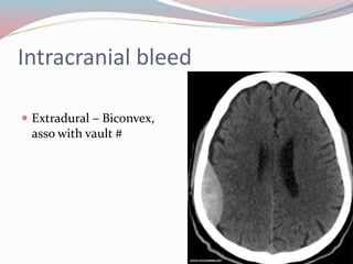 Intracranial bleed
 Extradural – Biconvex,
asso with vault #
 