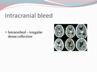 Intracranial bleed
 Intracerbral – irregular
dense collection
 