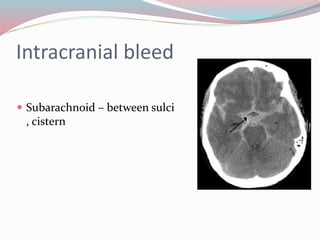 Intracranial bleed
 Subarachnoid – between sulci
, cistern
 