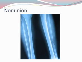 Nonunion
 