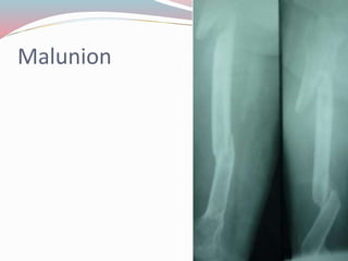 Malunion
 
