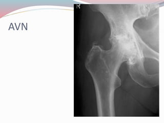 AVN
 