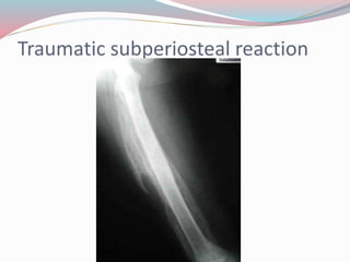Traumatic subperiosteal reaction
 