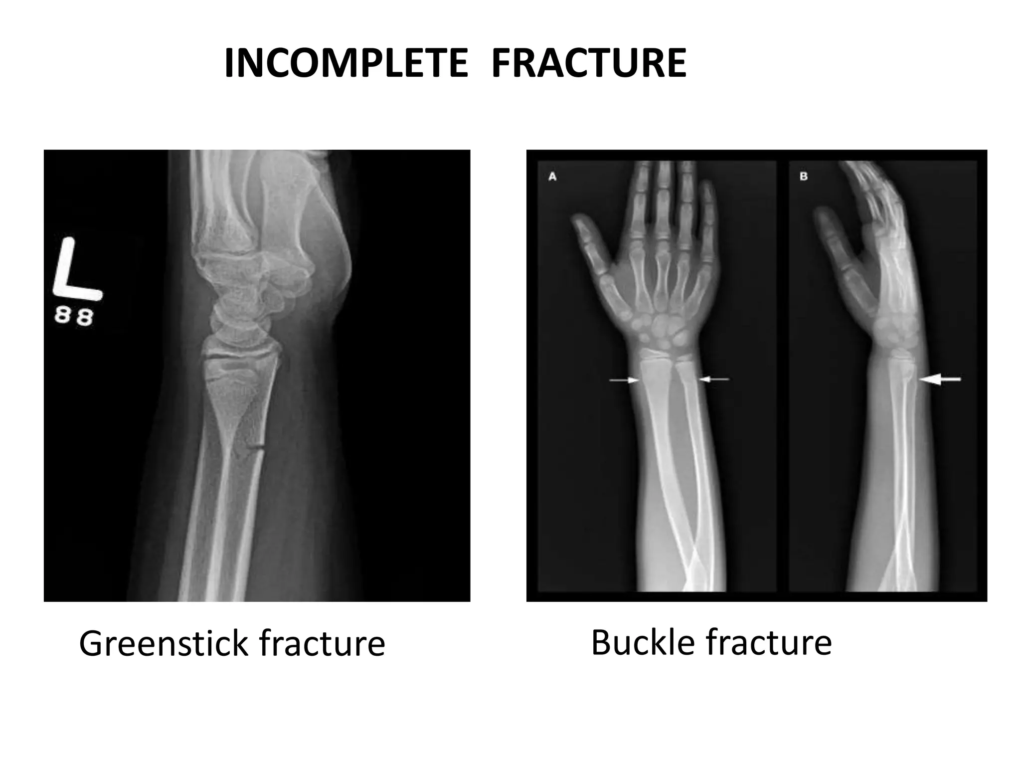 Incomplete Break imaging in skeletal trauma.ppt