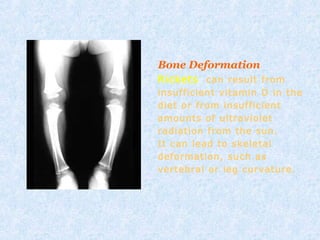 Bone Deformation
Rickets can result from
insufficient vitamin D in the
diet or from insufficient
amounts of ultraviolet
radiation from the sun.
It can lead to skeletal
deformation, such as
vertebral or leg curvature.
 