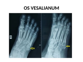 OS VESALIANUM
 
