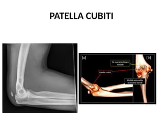 PATELLA CUBITI
 
