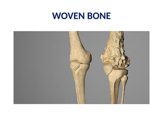 WOVEN BONE
 