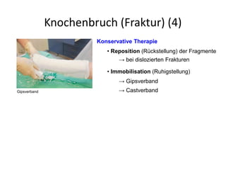 Knochenbruch (Fraktur) (4)
Konservative Therapie
• Reposition (Rückstellung) der Fragmente
→ bei dislozierten Frakturen
→ Gipsverband
• Immobilisation (Ruhigstellung)
Gipsverband → Castverband
 