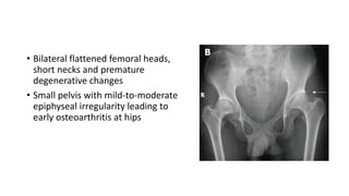 • Bilateral flattened femoral heads,
short necks and premature
degenerative changes
• Small pelvis with mild-to-moderate
epiphyseal irregularity leading to
early osteoarthritis at hips
 