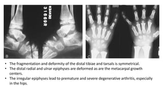 • The fragmentation and deformity of the distal tibiae and tarsals is symmetrical.
• The distal radial and ulnar epiphyses are deformed as are the metacarpal growth
centers.
• The irregular epiphyses lead to premature and severe degenerative arthritis, especially
in the hips.
 