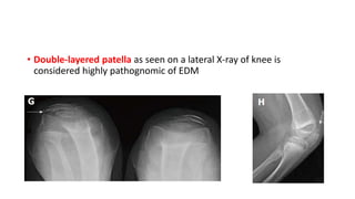 • Double-layered patella as seen on a lateral X-ray of knee is
considered highly pathognomic of EDM
 
