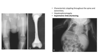 • Characteristic stippling throughout the spine and
extremities.
• Hepatosplenomegaly.
• Asymmetric limb shortening.
 