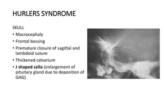 HURLERS SYNDROME
SKULL
• Macrocephaly
• Frontal bossing
• Premature closure of sagittal and
lambdoid suture
• Thickened calvarium
• J shaped sella (enlargement of
pituitary gland due to deposition of
GAG)
 