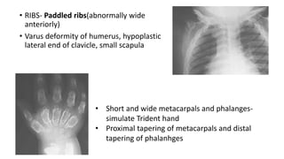 • RIBS- Paddled ribs(abnormally wide
anteriorly)
• Varus deformity of humerus, hypoplastic
lateral end of clavicle, small scapula
• Short and wide metacarpals and phalanges-
simulate Trident hand
• Proximal tapering of metacarpals and distal
tapering of phalanhges
 