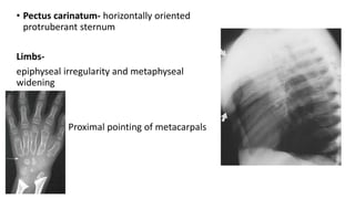 • Pectus carinatum- horizontally oriented
protruberant sternum
Limbs-
epiphyseal irregularity and metaphyseal
widening
Proximal pointing of metacarpals
 