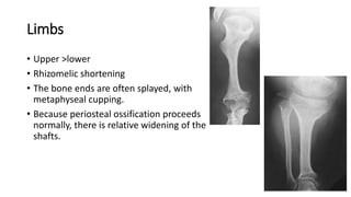 Limbs
• Upper >lower
• Rhizomelic shortening
• The bone ends are often splayed, with
metaphyseal cupping.
• Because periosteal ossification proceeds
normally, there is relative widening of the
shafts.
 