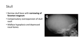 Skull
• Narrow skull base with narrowing of
foramen magnum
• Compensatory overexpansion of skull
vault
• Midface hypoplasia and depressed
nasal bones
 