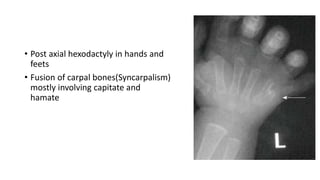 • Post axial hexodactyly in hands and
feets
• Fusion of carpal bones(Syncarpalism)
mostly involving capitate and
hamate
 