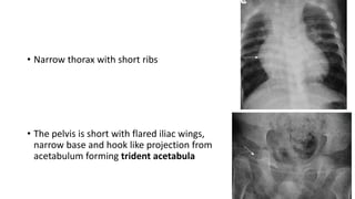 • Narrow thorax with short ribs
• The pelvis is short with flared iliac wings,
narrow base and hook like projection from
acetabulum forming trident acetabula
 