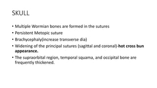 SKULL
• Multiple Wormian bones are formed in the sutures
• Persistent Metopic suture
• Brachycephaly(increase transverse dia)
• Widening of the principal sutures (sagittal and coronal)-hot cross bun
appearance.
• The supraorbital region, temporal squama, and occipital bone are
frequently thickened.
 