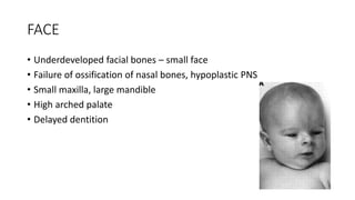 FACE
• Underdeveloped facial bones – small face
• Failure of ossification of nasal bones, hypoplastic PNS
• Small maxilla, large mandible
• High arched palate
• Delayed dentition
 