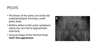 PELVIS
• The bones of the pelvis are small and
underdeveloped, forming a small
pelvic bowl.
• Midline defect at the pubic symphysis-
where the rami fail to approximate
anteriorly.
• Unusual shape of the femoral head,
chef’s hat appearence
 