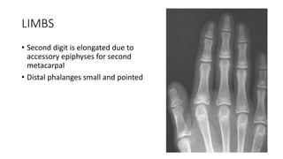 LIMBS
• Second digit is elongated due to
accessory epiphyses for second
metacarpal
• Distal phalanges small and pointed
 