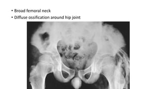 • Broad femoral neck
• Diffuse ossification around hip joint
 