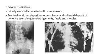 • Ectopic ossification
• Initially scute inflammation-soft tissue masses.
• Eventually calcium deposition occurs, linear and spheroid deposit of
bone are seen along tendon, ligaments, fascia and muscles
 
