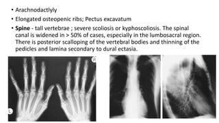 • Arachnodactlyly
• Elongated osteopenic ribs; Pectus excavatum
• Spine - tall vertebrae ; severe scoliosis or kyphoscoliosis. The spinal
canal is widened in > 50% of cases, especially in the lumbosacral region.
There is posterior scalloping of the vertebral bodies and thinning of the
pedicles and lamina secondary to dural ectasia.
 