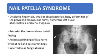 NAIL PATELLA SYNDROME
• Dysplastic fingernails, small or absent patellae, bony deformities of
the pelvis and elbows, iliac horns, numerous soft tissue
abnormalities, and renal dysplasia
• Posterior iliac horns- characteristic
finding
• An isolated finding of iliac horns
without nail and patellar findings,
is referred to as Fong’s disease
 