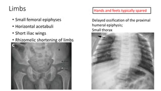 Limbs
• Small femoral epiphyses
• Horizontal acetabuli
• Short iliac wings
• Rhizomelic shortening of limbs
Delayed ossification of the proximal
humeral epiphysis;
Small thorax
Hands and feets typically spared
 