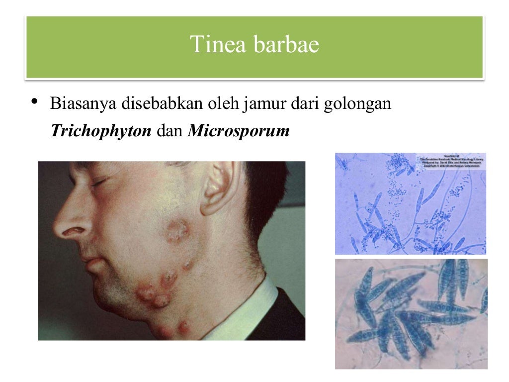 Skenario 20.5 Dermatofitosis & Non-dermatofitosis