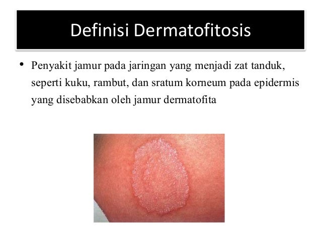 Skenario 20 5 Dermatofitosis Non dermatofitosis