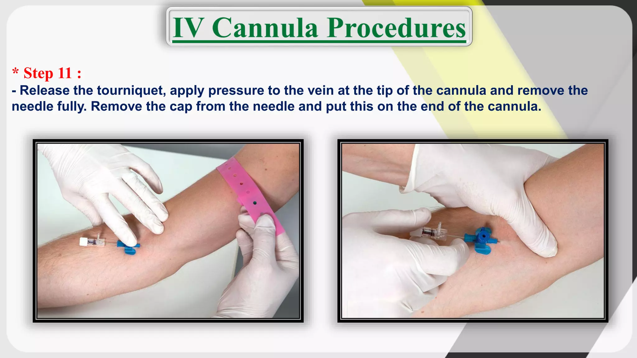 * Step 11 :
- Release the tourniquet, apply pressure to the vein at the tip of the cannula and remove the
needle fully. Remove the cap from the needle and put this on the end of the cannula.
 