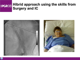 Hibrid approach using the skills from Surgery and IC 