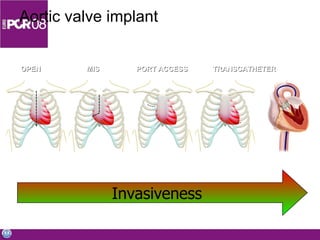 Aortic valve implant OPEN    MIS   PORT ACCESS TRANSCATHETER  Invasiveness 