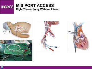 MIS PORT ACCESS  Right Thoracotomy With Necklines 
