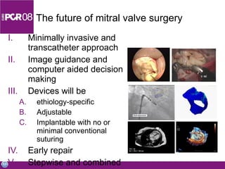 The future of mitral valve surgery Minimally invasive and transcatheter approach Image guidance and computer aided decision making Devices will be ethiology-specific Adjustable Implantable with no or minimal conventional suturing Early repair Stepwise and combined strategies 