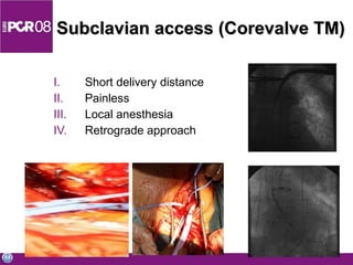 Subclavian access (Corevalve TM) Short delivery distance Painless Local anesthesia Retrograde approach 