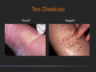 Tes Diaskopi
Positif Negatif
 