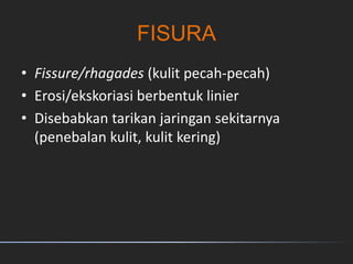 FISURA
• Fissure/rhagades (kulit pecah-pecah)
• Erosi/ekskoriasi berbentuk linier
• Disebabkan tarikan jaringan sekitarnya
(penebalan kulit, kulit kering)
 