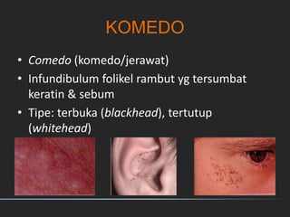 KOMEDO
• Comedo (komedo/jerawat)
• Infundibulum folikel rambut yg tersumbat
keratin & sebum
• Tipe: terbuka (blackhead), tertutup
(whitehead)
 
