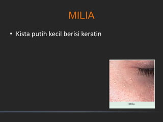 MILIA
• Kista putih kecil berisi keratin
 