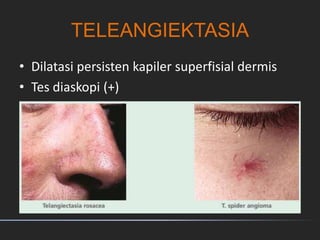 TELEANGIEKTASIA
• Dilatasi persisten kapiler superfisial dermis
• Tes diaskopi (+)
 