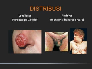 DISTRIBUSI
Lokalisata
(terbatas pd 1 regio)
Regional
(mengenai beberapa regio)
 