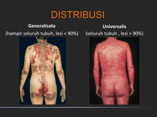 Generalisata
(hampir seluruh tubuh, lesi < 90%)
Universalis
(seluruh tubuh , lesi > 90%)
DISTRIBUSI
 