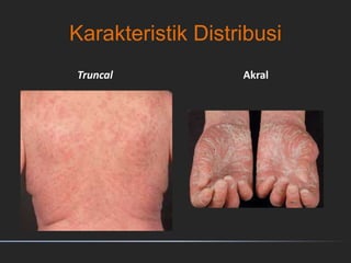 Karakteristik Distribusi
Truncal Akral
 